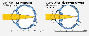 correction-hypermetropie