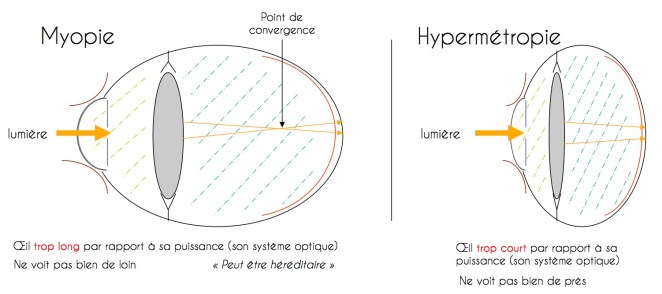 oeil_myope_et_hypem